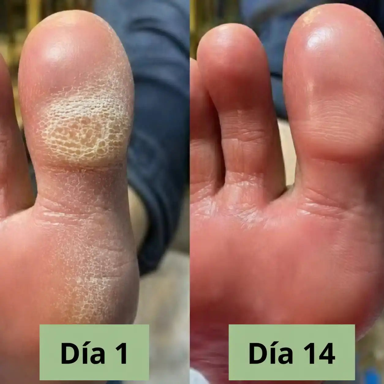 JABÓN ANTIMICOTICO | Lávate. Trátate. No vuelvas a esconder tu piel ✨