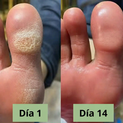 JABÓN ANTIMICOTICO | Lávate. Trátate. No vuelvas a esconder tu piel ✨