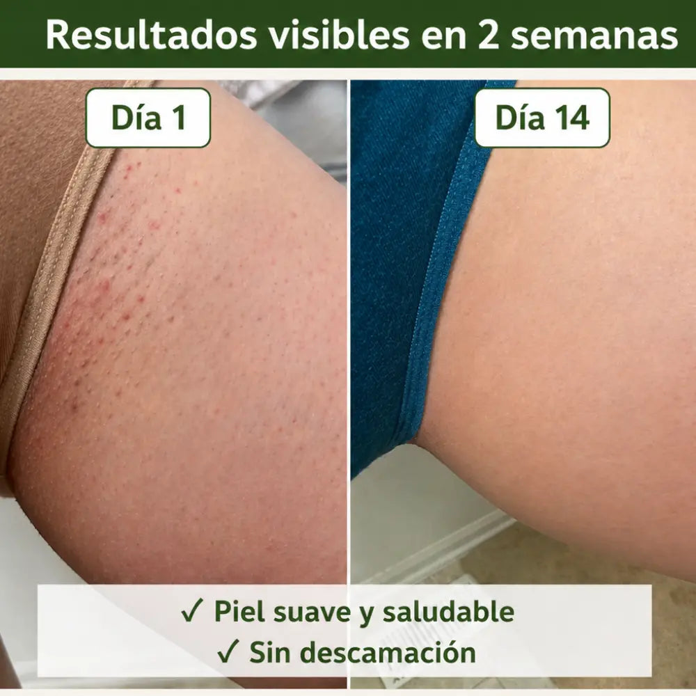 JABÓN ANTIMICOTICO | Lávate. Trátate. No vuelvas a esconder tu piel ✨