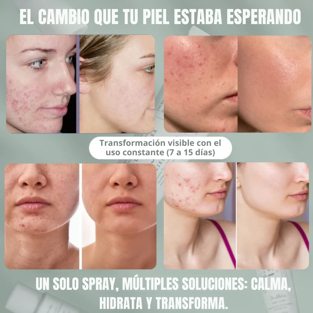 345 RELIEF SPRAY | Ciencia coreana para la pieles con brotes, rosácea y acné inflamatorio ✨