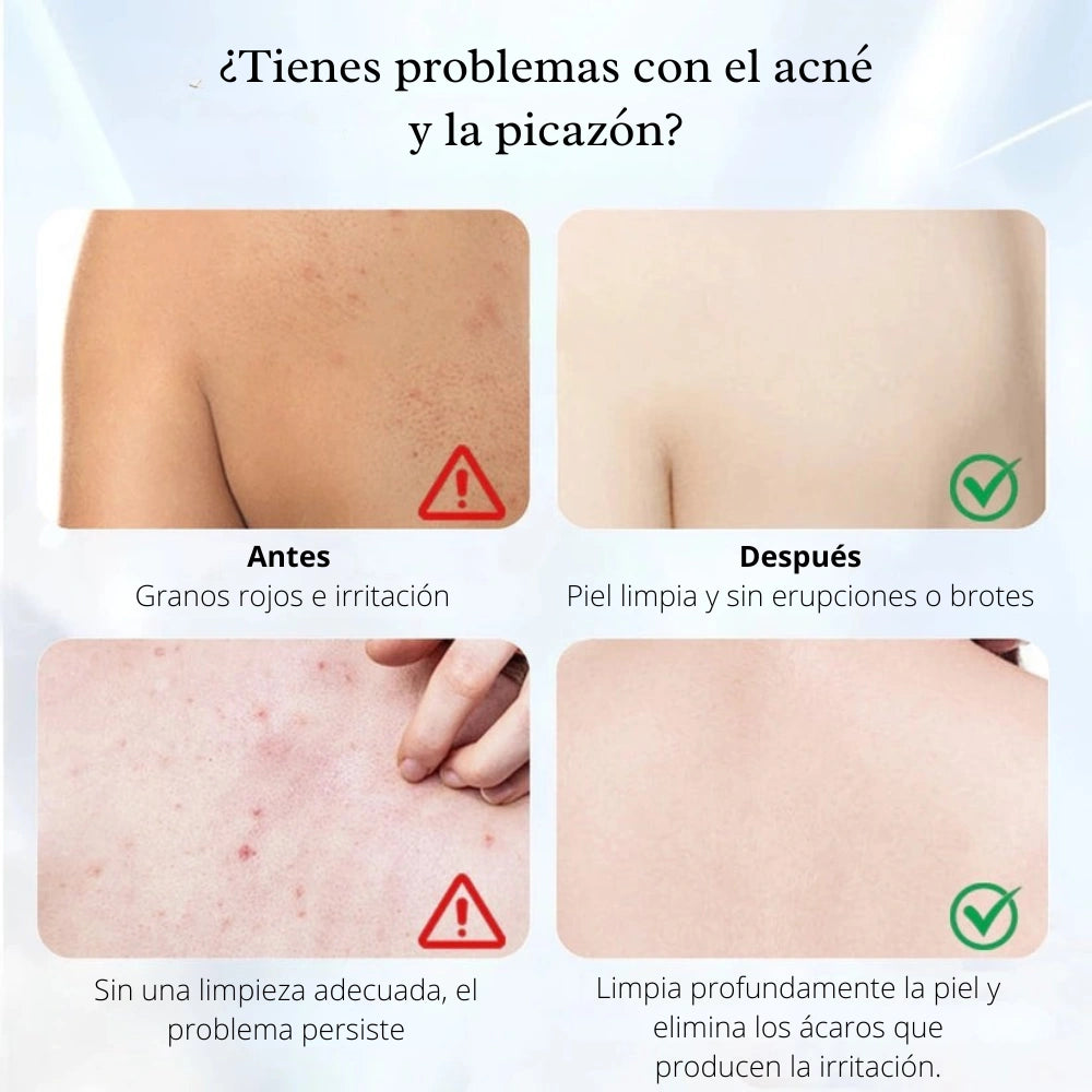QUARXERY MITE & ACNE® | Jabón liquido corporal de limpieza ultra profunda 🧴
