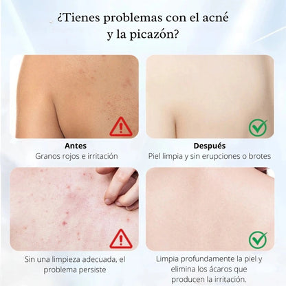 QUARXERY MITE & ACNE® | Jabón liquido corporal de limpieza ultra profunda 🧴