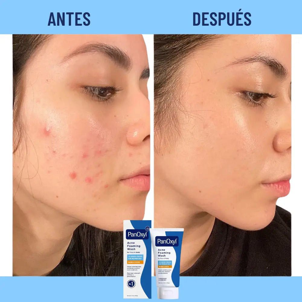 PanOxyl® | Jabón de limpieza para el acné con Peróxido de Benzoilo ✨